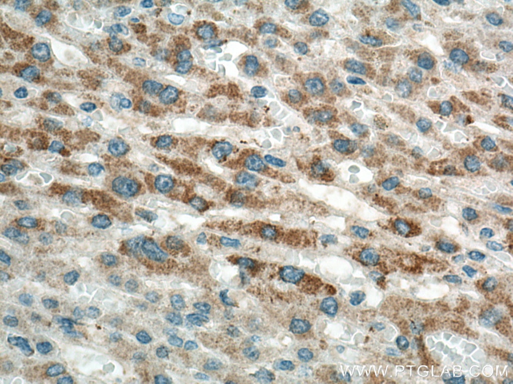 Immunohistochemistry (IHC) staining of human liver cancer tissue using OAT Polyclonal antibody (17089-1-AP)