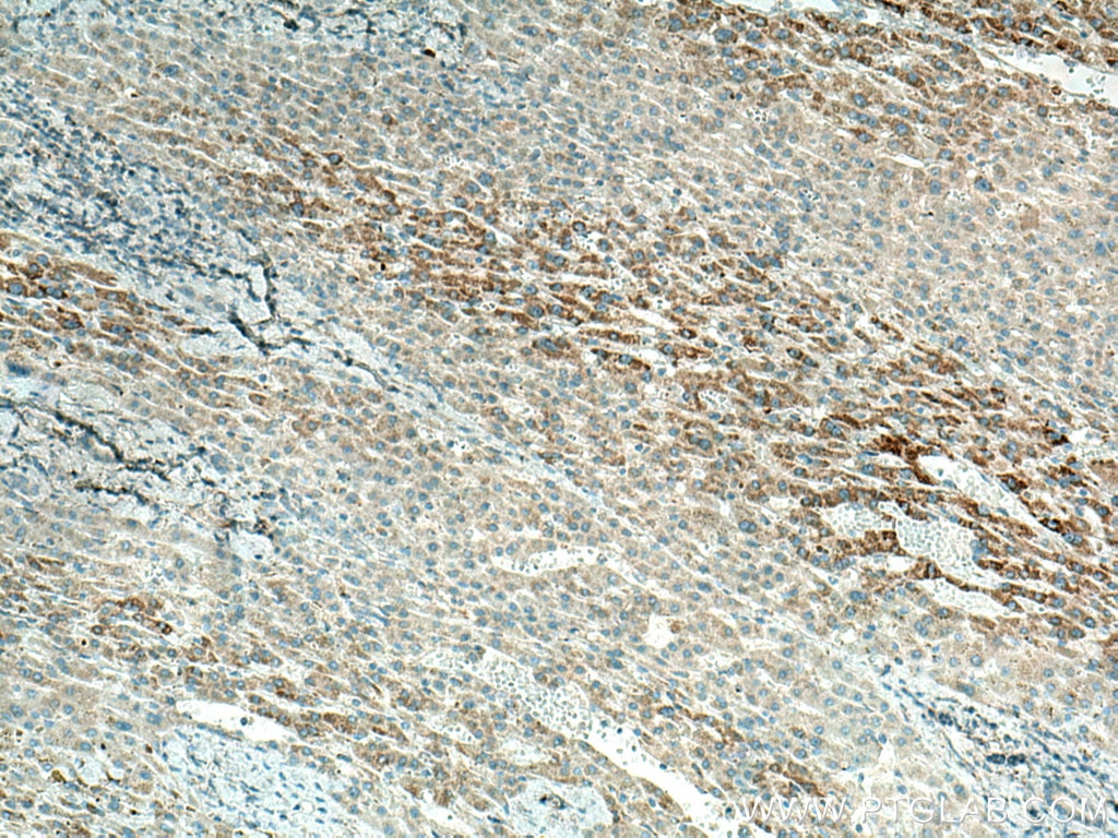 Immunohistochemistry (IHC) staining of human liver cancer tissue using OAT Polyclonal antibody (17089-1-AP)