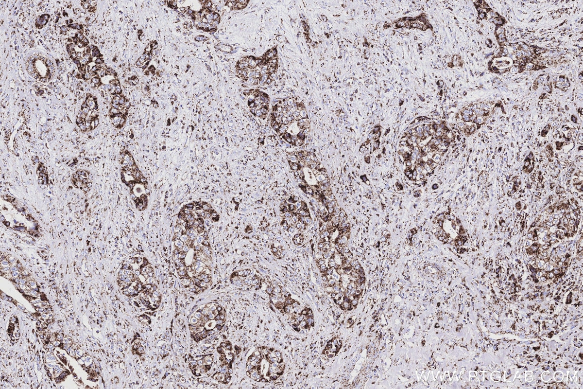 Immunohistochemistry (IHC) staining of human pancreas cancer tissue using OAT Recombinant monoclonal antibody (85218-2-RR)