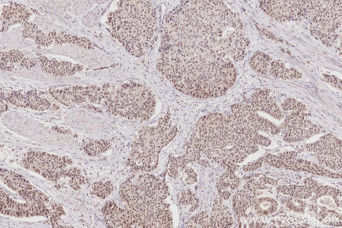 Immunohistochemistry (IHC) staining of human stomach cancer tissue using OBFC2B Polyclonal antibody (14809-1-AP)
