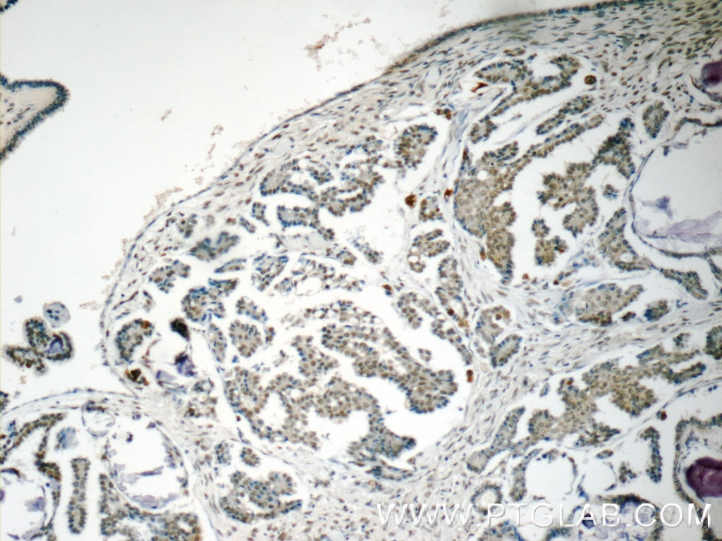 IHC staining of human ovary tumor using 14809-1-AP