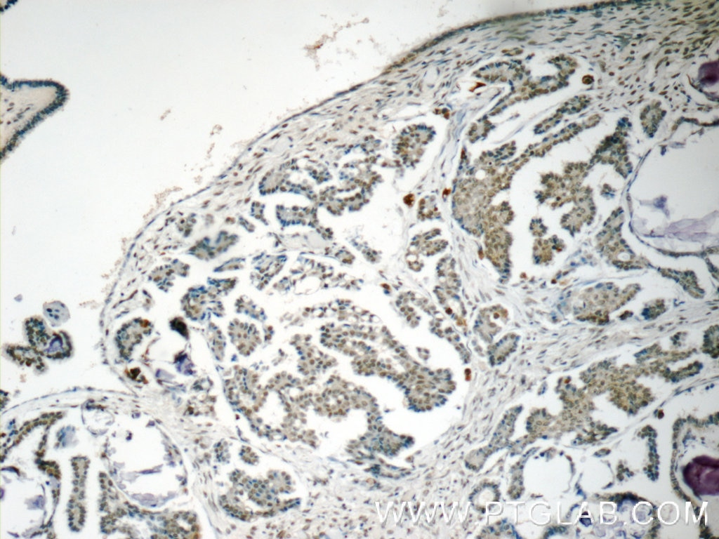 Immunohistochemistry (IHC) staining of human ovary tumor tissue using OBFC2B Polyclonal antibody (14809-1-AP)