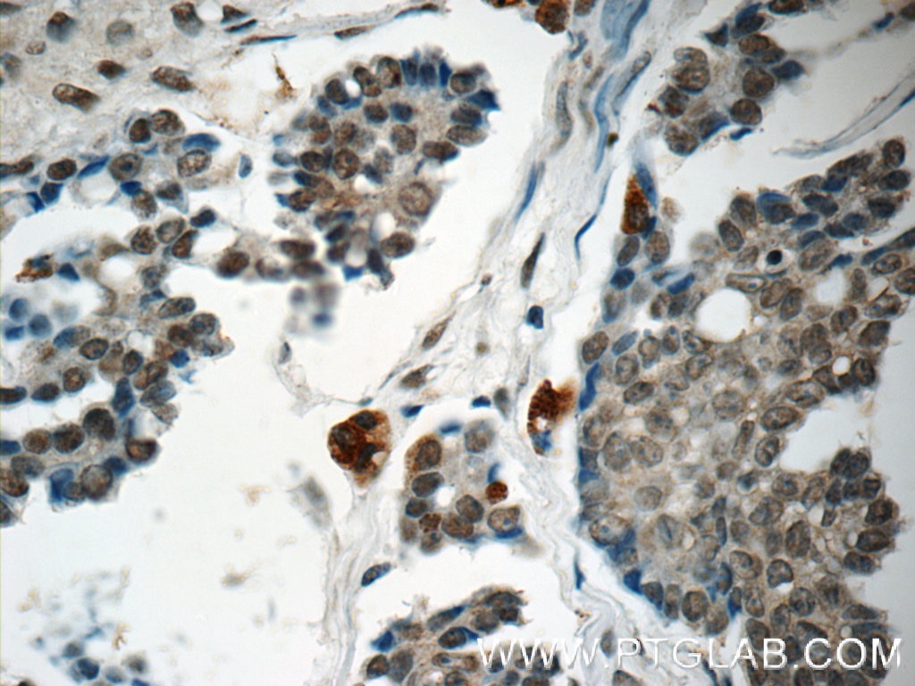 Immunohistochemistry (IHC) staining of human ovary tumor tissue using OBFC2B Polyclonal antibody (14809-1-AP)