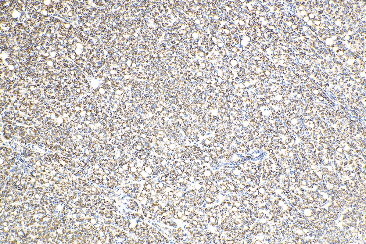 Immunohistochemistry (IHC) staining of human liver cancer tissue using OCIAD1 Polyclonal antibody (16634-1-AP)