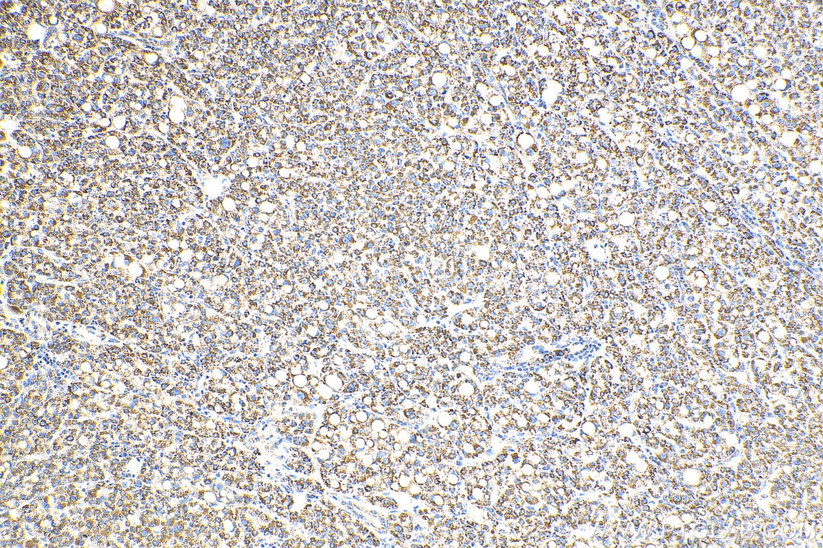 IHC staining of human liver cancer using 16634-1-AP