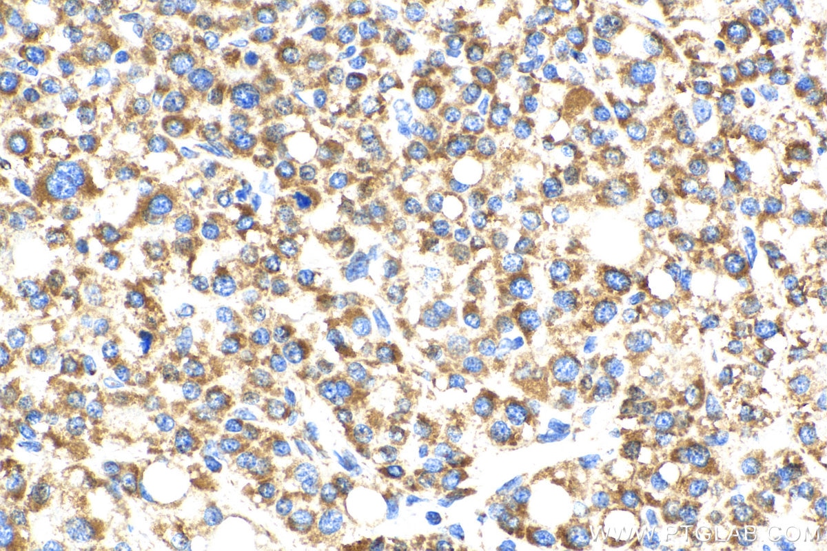 IHC staining of human liver cancer using 16634-1-AP
