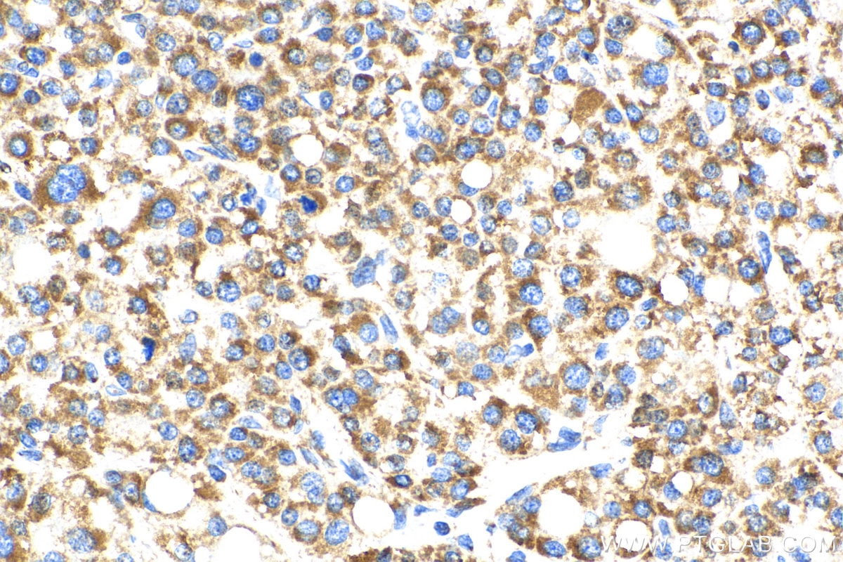 Immunohistochemistry (IHC) staining of human liver cancer tissue using OCIAD1 Polyclonal antibody (16634-1-AP)