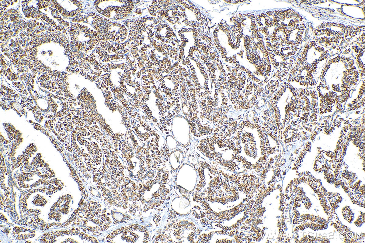 IHC staining of human thyroid cancer using 16634-1-AP