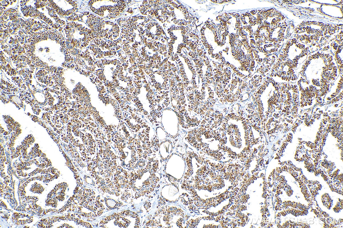 Immunohistochemistry (IHC) staining of human thyroid cancer tissue using OCIAD1 Polyclonal antibody (16634-1-AP)