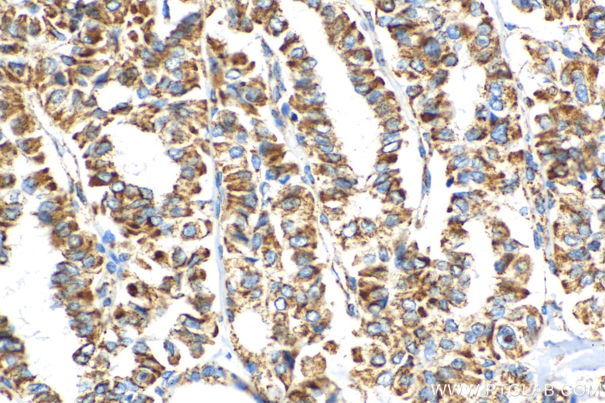 Immunohistochemistry (IHC) staining of human thyroid cancer tissue using OCIAD1 Polyclonal antibody (16634-1-AP)