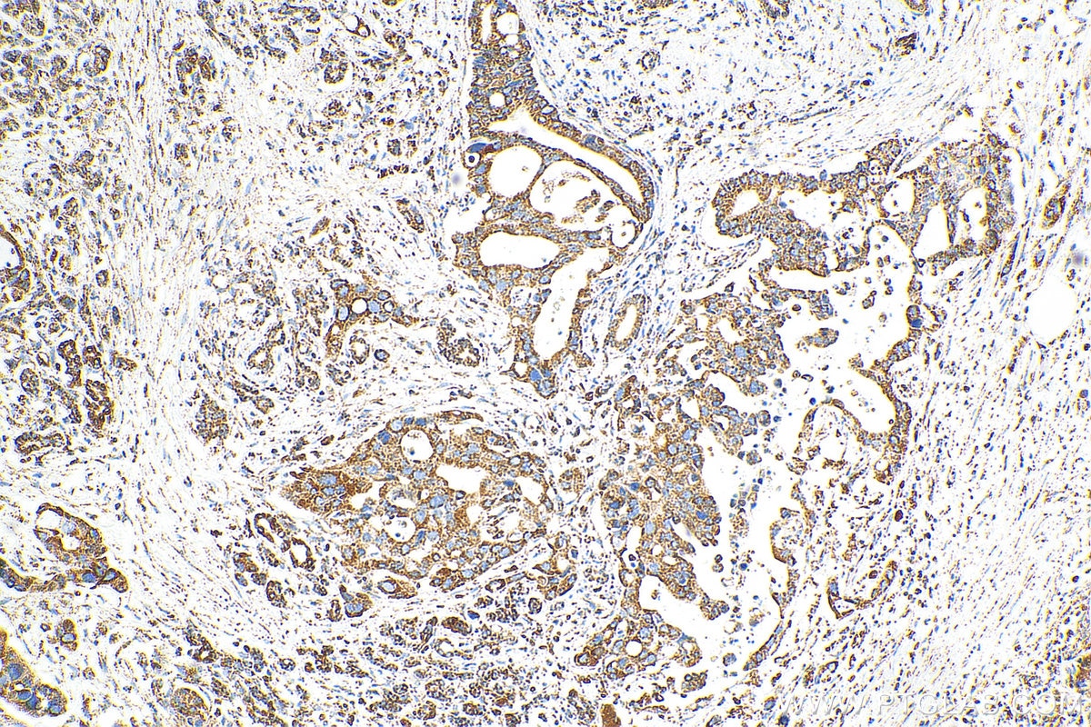 Immunohistochemistry (IHC) staining of human pancreas cancer tissue using OCIAD1 Polyclonal antibody (16634-1-AP)