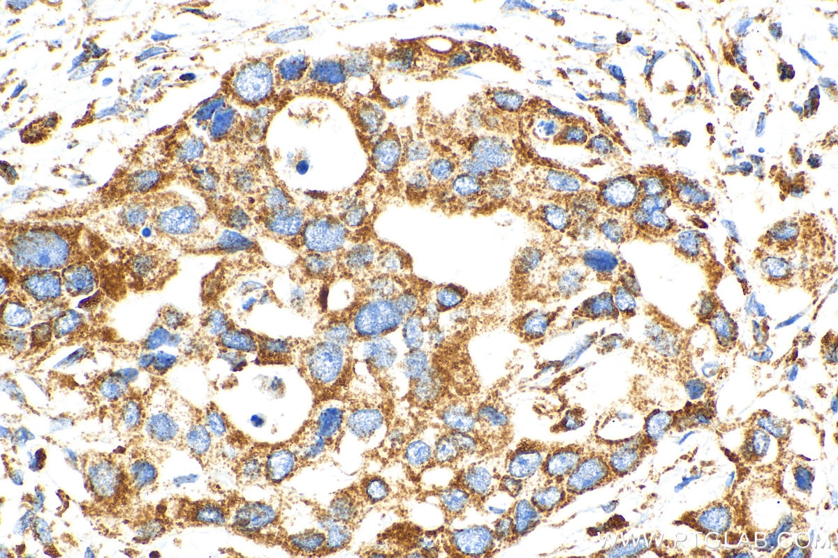 Immunohistochemistry (IHC) staining of human pancreas cancer tissue using OCIAD1 Polyclonal antibody (16634-1-AP)