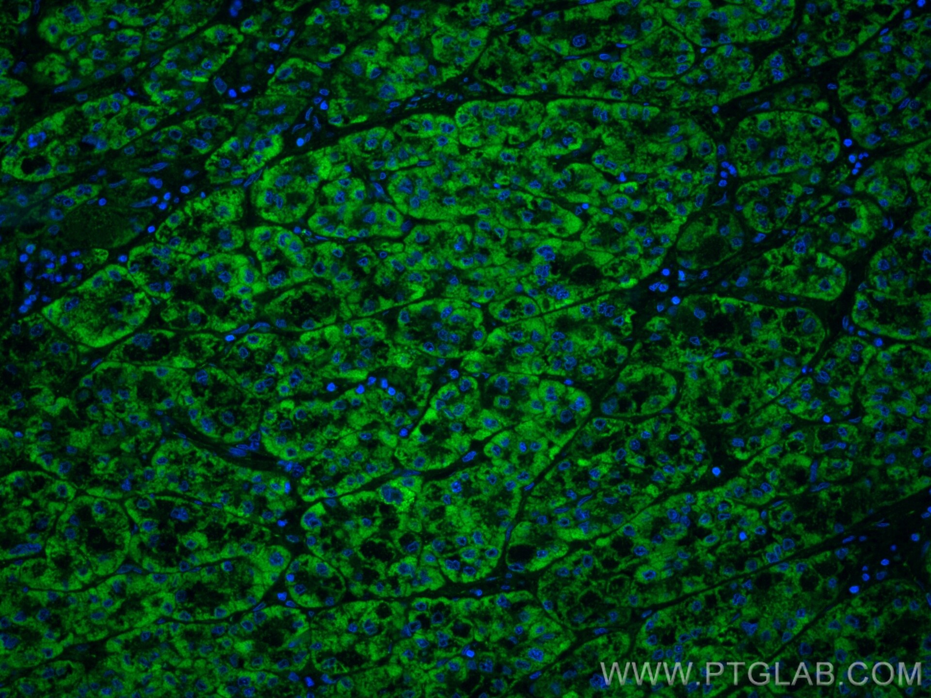 Immunofluorescence (IF) / fluorescent staining of human liver cancer tissue using OCIAD1 Monoclonal antibody (66698-1-Ig)