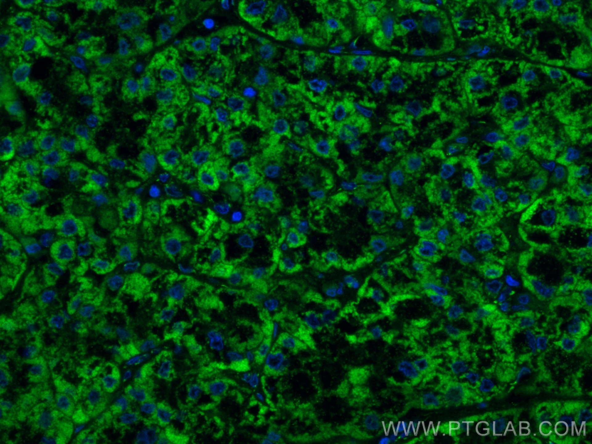 Immunofluorescence (IF) / fluorescent staining of human liver cancer tissue using OCIAD1 Monoclonal antibody (66698-1-Ig)