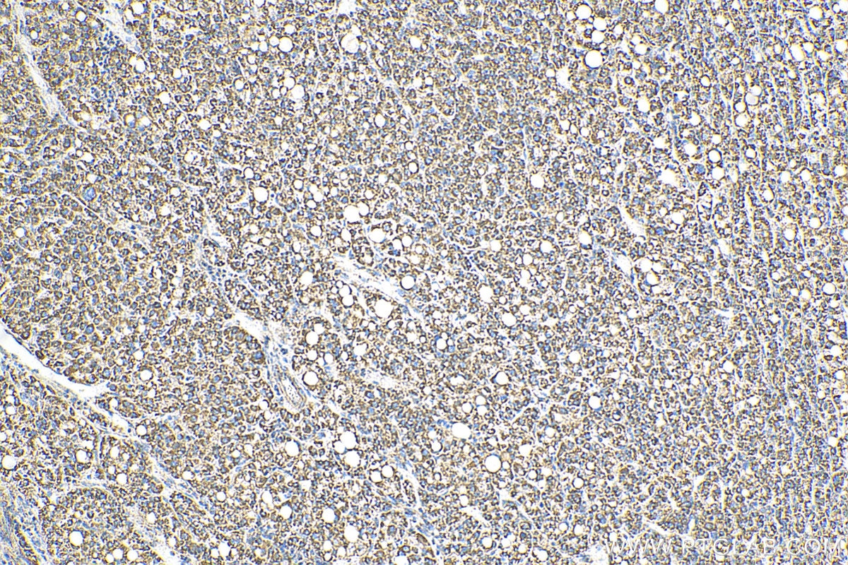 Immunohistochemistry (IHC) staining of human liver cancer tissue using OCIAD1 Monoclonal antibody (66698-1-Ig)