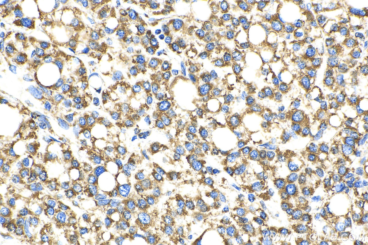 Immunohistochemistry (IHC) staining of human liver cancer tissue using OCIAD1 Monoclonal antibody (66698-1-Ig)