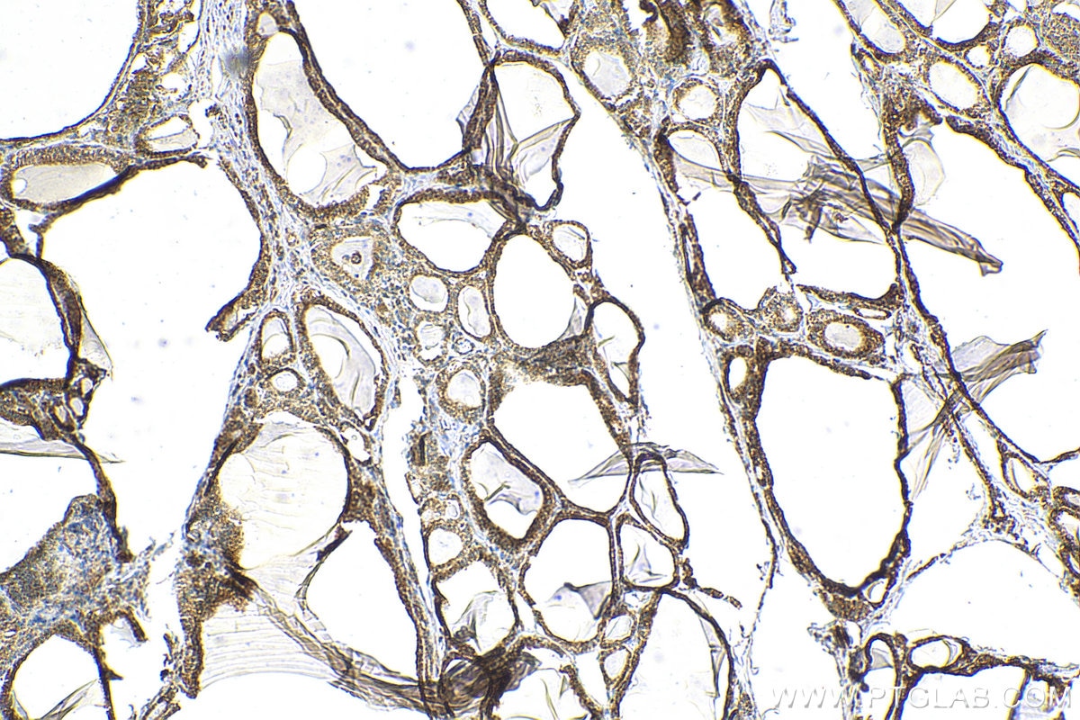Immunohistochemistry (IHC) staining of human thyroid cancer tissue using OCIAD1 Monoclonal antibody (66698-1-Ig)