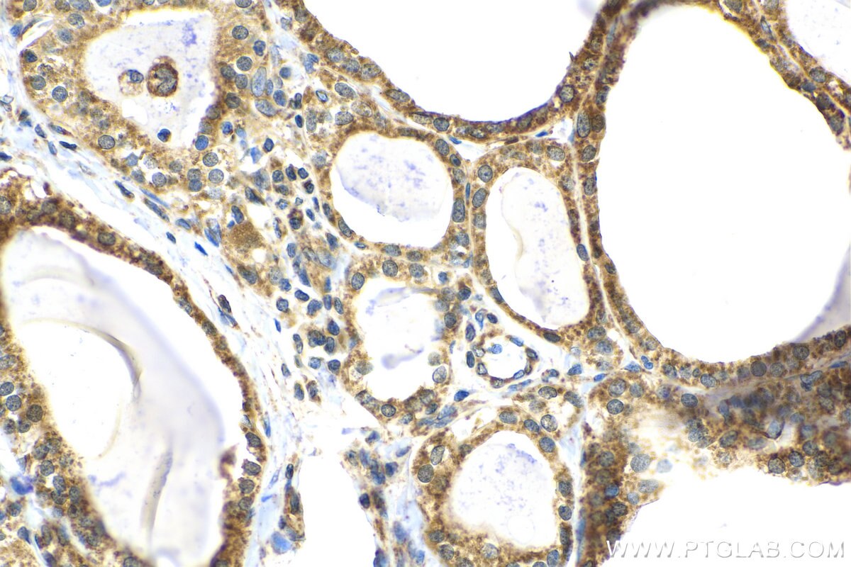 Immunohistochemistry (IHC) staining of human thyroid cancer tissue using OCIAD1 Monoclonal antibody (66698-1-Ig)