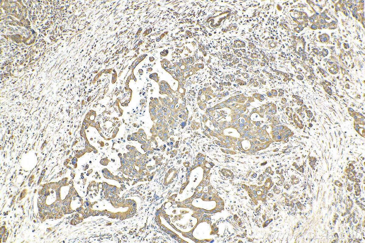 Immunohistochemistry (IHC) staining of human pancreas cancer tissue using OCIAD1 Monoclonal antibody (66698-1-Ig)