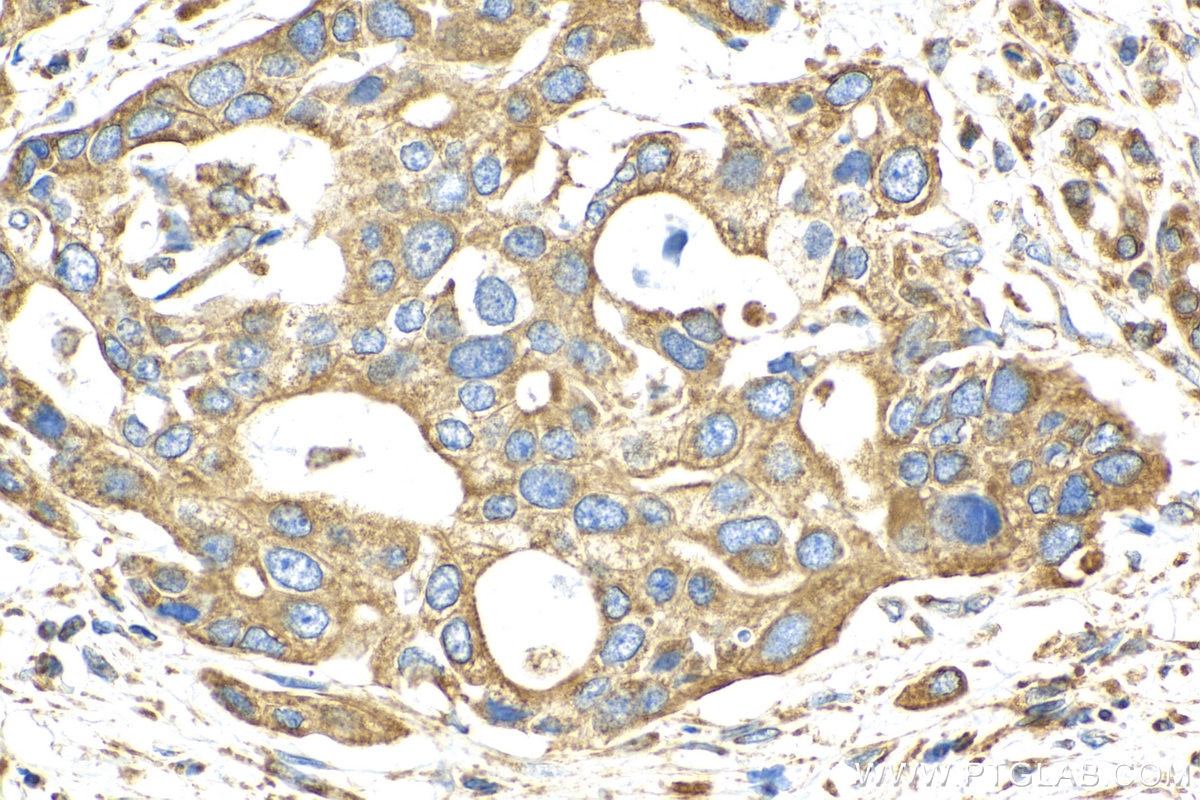 Immunohistochemistry (IHC) staining of human pancreas cancer tissue using OCIAD1 Monoclonal antibody (66698-1-Ig)