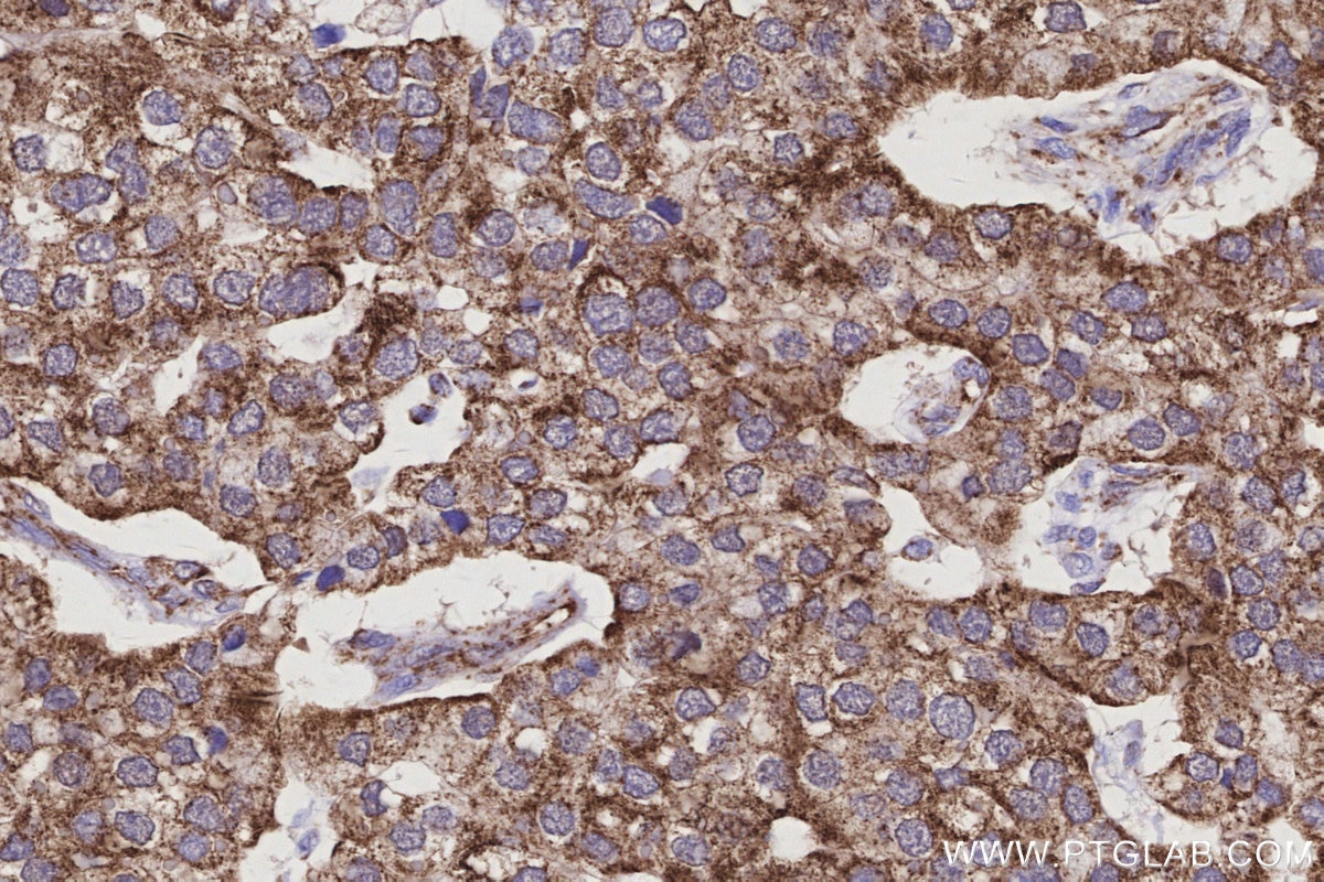 IHC staining of human stomach cancer using 66698-1-Ig Immunohistochemistry (IHC) staining of human stomach cancer tissue using OCIAD1 Monoclonal antibody (66698-1-Ig)