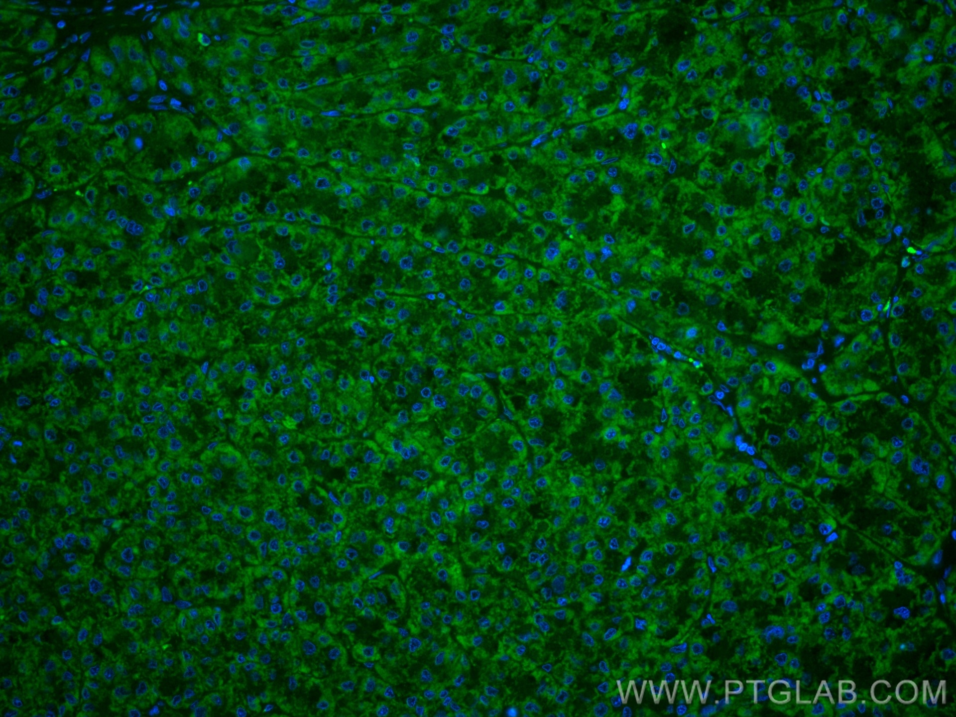 Immunofluorescence (IF) / fluorescent staining of human liver cancer tissue using CoraLite® Plus 488-conjugated OCIAD1 Monoclonal an (CL488-66698)