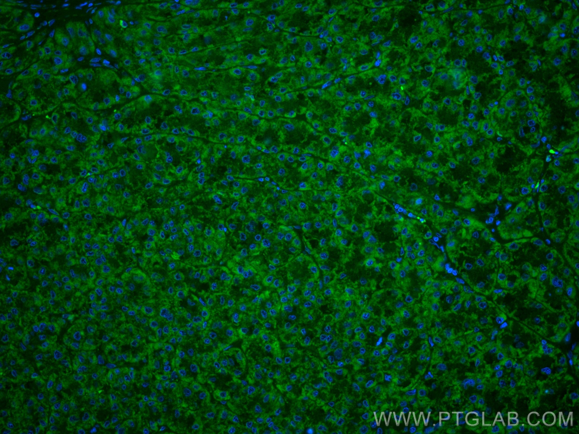 IF Staining of human liver cancer using CL488-66698