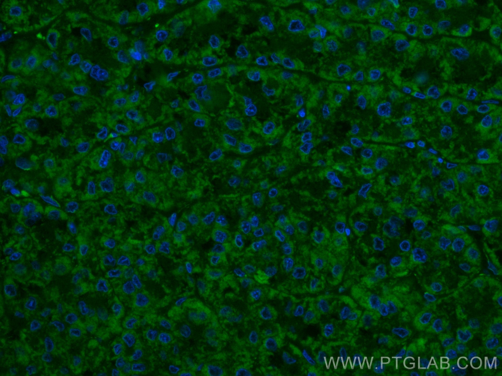 Immunofluorescence (IF) / fluorescent staining of human liver cancer tissue using CoraLite® Plus 488-conjugated OCIAD1 Monoclonal an (CL488-66698)