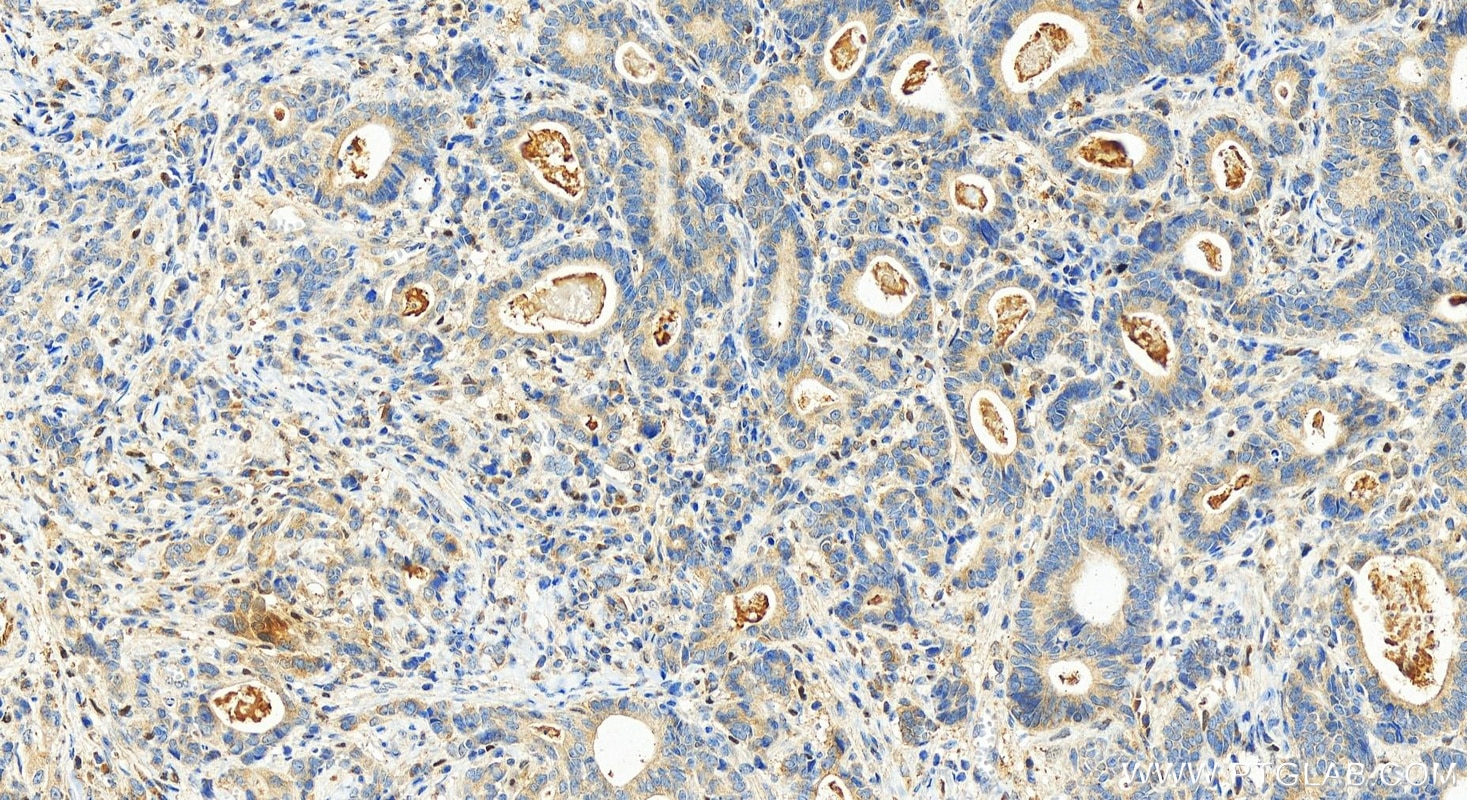 Immunohistochemistry (IHC) staining of human stomach cancer tissue using OCIAD2 Polyclonal antibody (13437-1-AP)