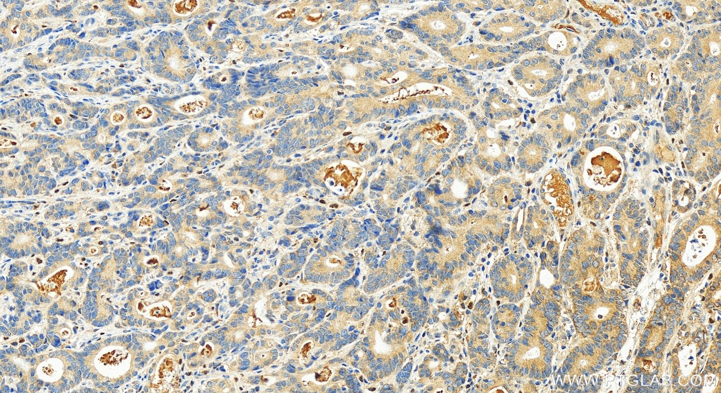 Immunohistochemistry (IHC) staining of human stomach cancer tissue using OCIAD2 Polyclonal antibody (13437-1-AP)