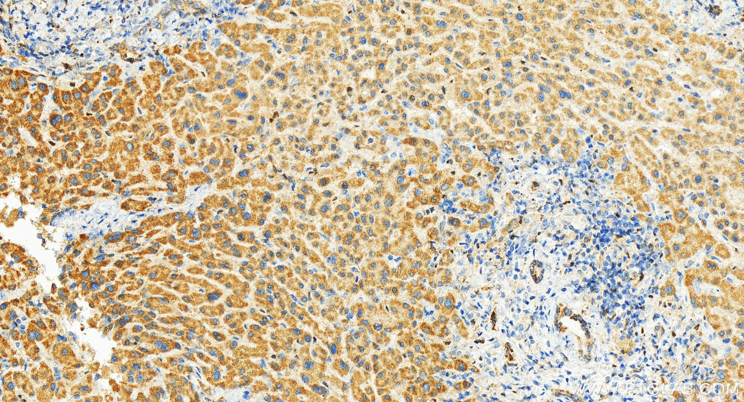 Immunohistochemistry (IHC) staining of human intrahepatic cholangiocarcinoma tissue using OCIAD2 Polyclonal antibody (13437-1-AP)