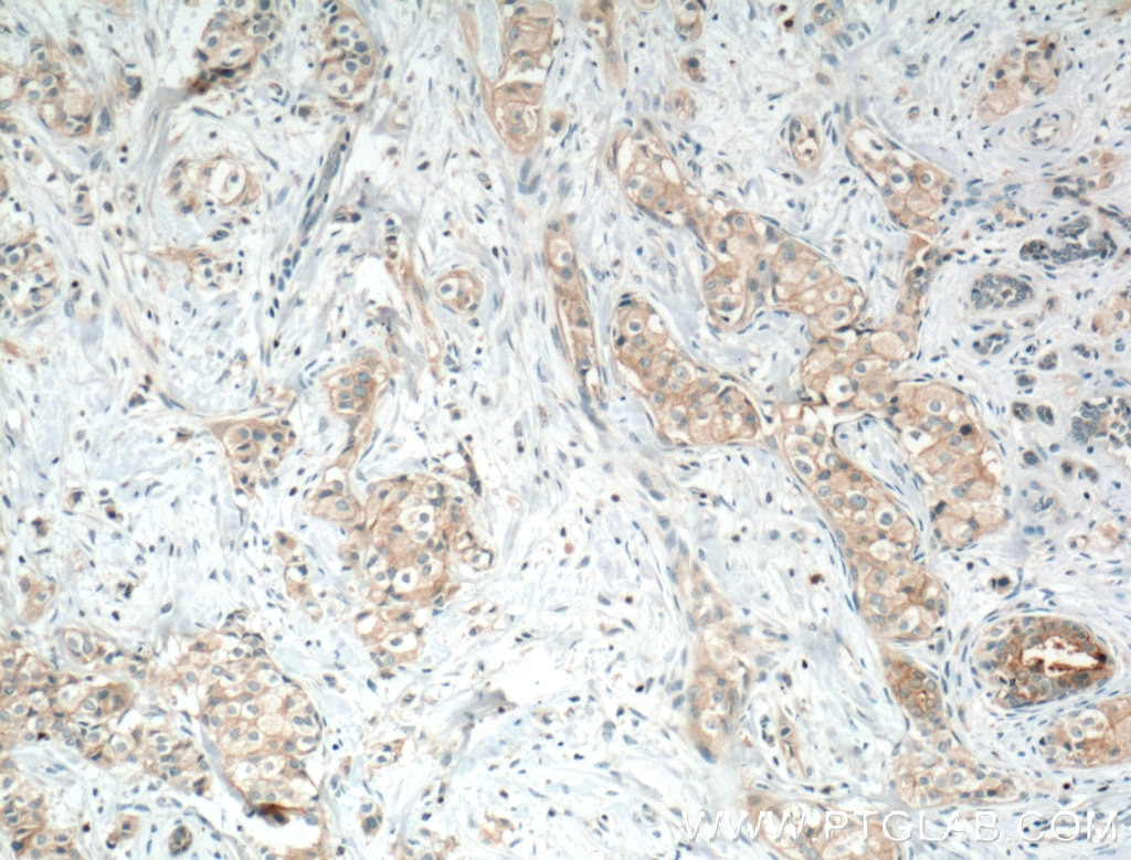 Immunohistochemistry (IHC) staining of human breast cancer tissue using Occludin Polyclonal antibody (13409-1-AP)