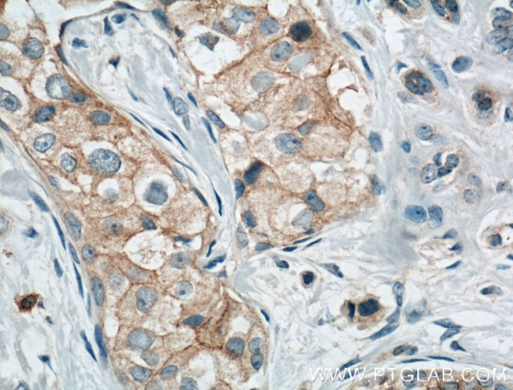 Immunohistochemistry (IHC) staining of human breast cancer tissue using Occludin Polyclonal antibody (13409-1-AP)