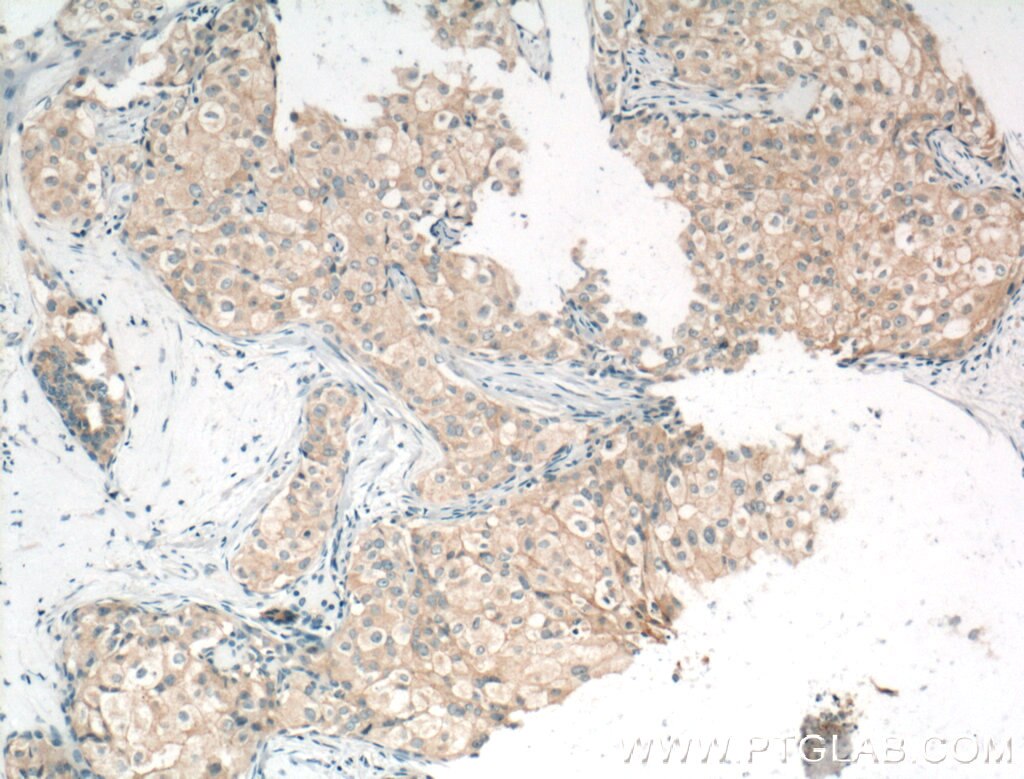 Immunohistochemistry (IHC) staining of human breast cancer tissue using Occludin Polyclonal antibody (13409-1-AP)