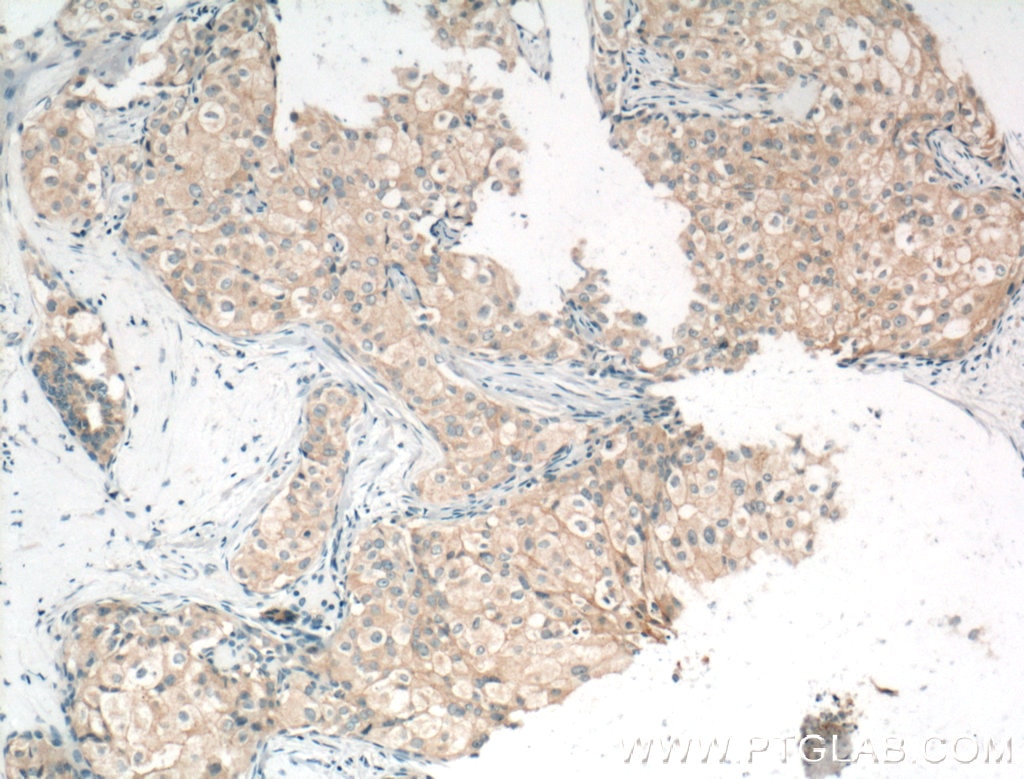 IHC staining of human breast cancer using 13409-1-AP