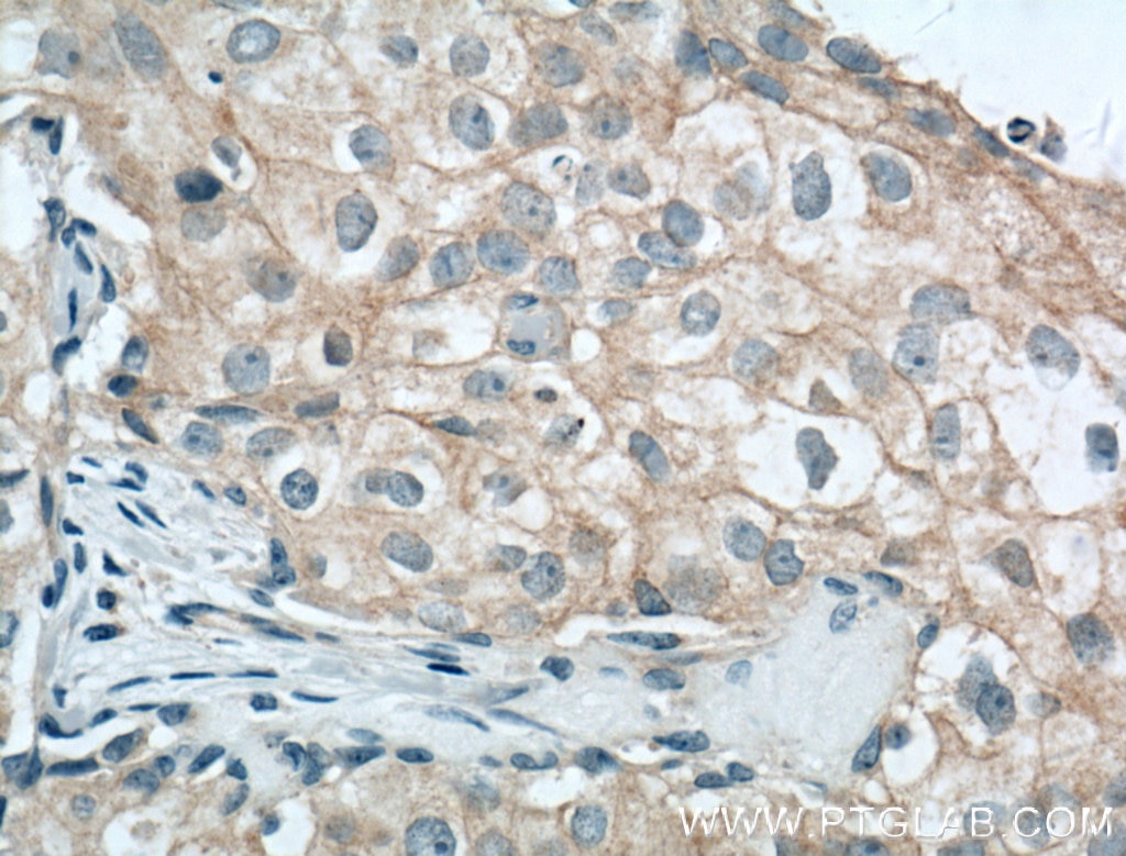 Immunohistochemistry (IHC) staining of human breast cancer tissue using Occludin Polyclonal antibody (13409-1-AP)
