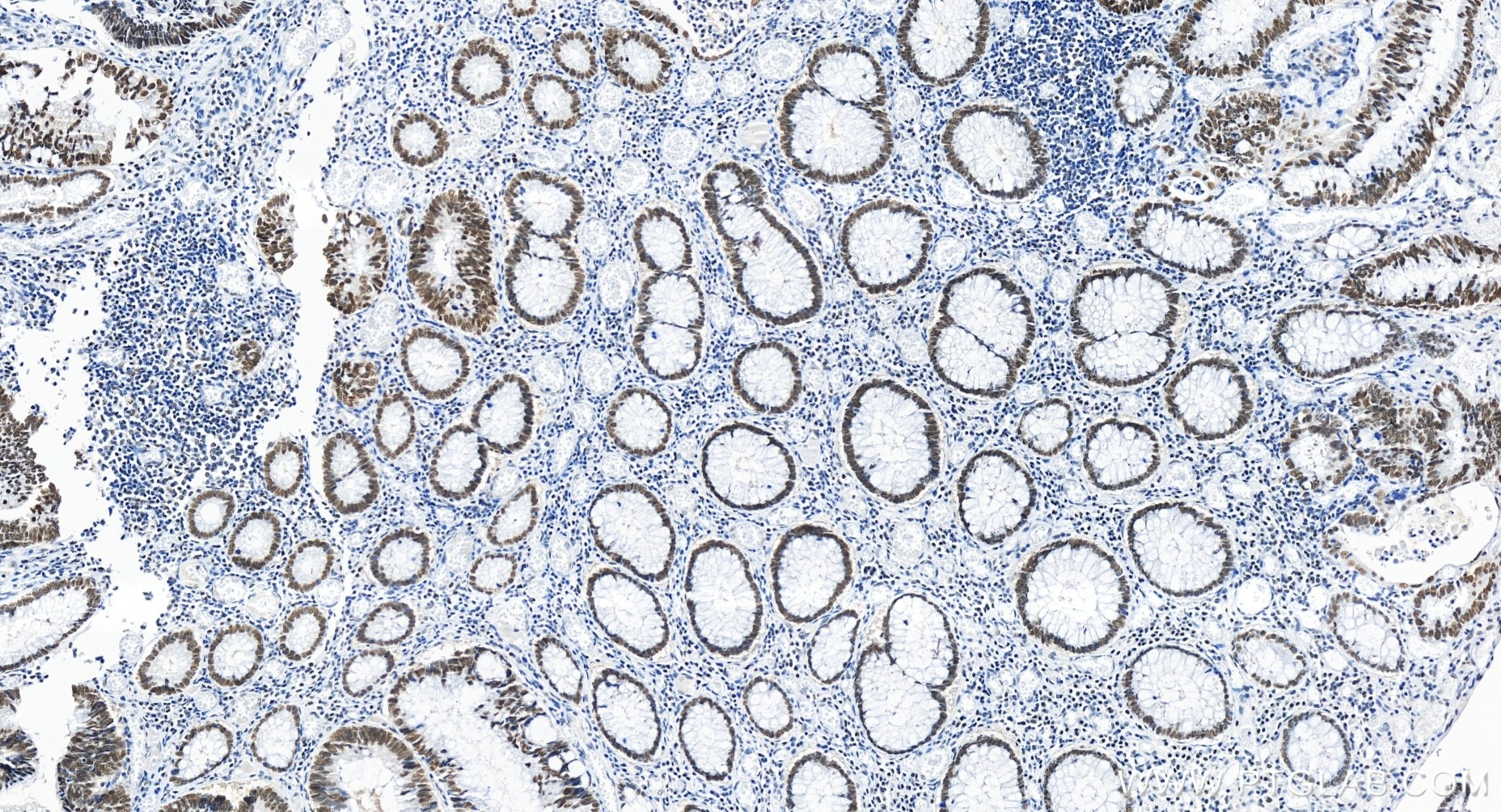 Immunohistochemistry (IHC) staining of human colon cancer tissue using OCT1 Recombinant antibody (85726-1-RR)