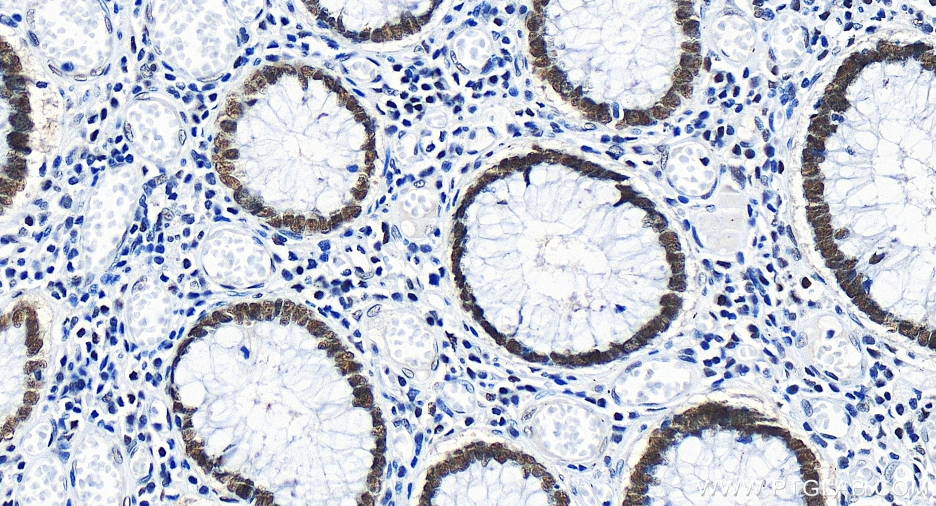 Immunohistochemistry (IHC) staining of human colon cancer tissue using OCT1 Recombinant antibody (85726-1-RR)