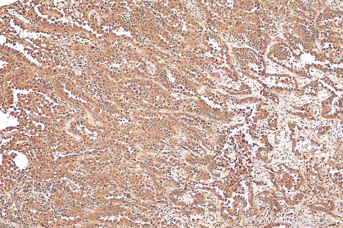 Immunohistochemistry (IHC) staining of human lung cancer tissue using OCT4/POU5F1 Polyclonal antibody (11263-1-AP)