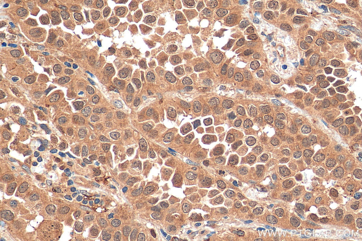 Immunohistochemistry (IHC) staining of human lung cancer tissue using OCT4/POU5F1 Polyclonal antibody (11263-1-AP)