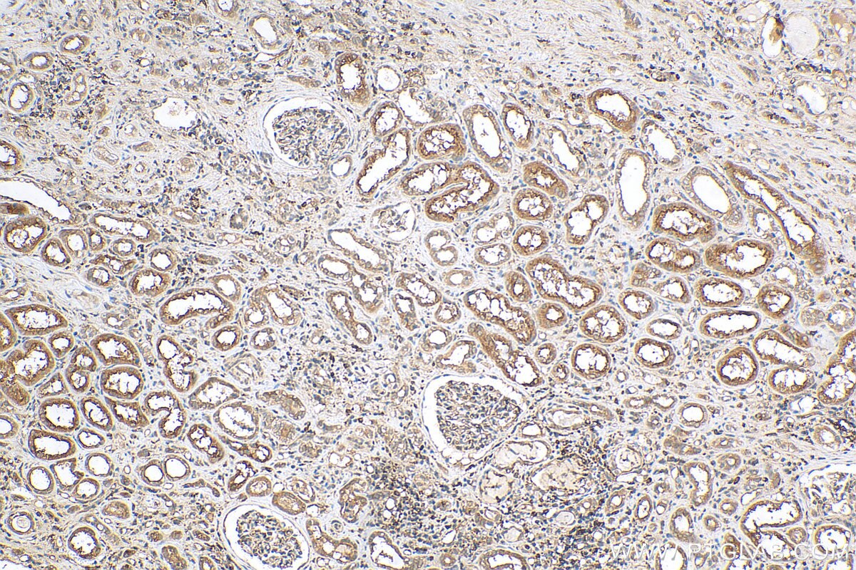 Immunohistochemistry (IHC) staining of human renal cell carcinoma tissue using OCT4/POU5F1 Polyclonal antibody (11263-1-AP)