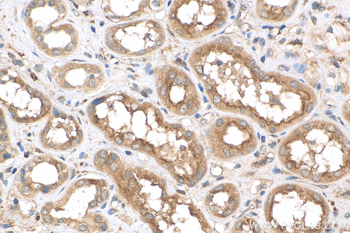 Immunohistochemistry (IHC) staining of human renal cell carcinoma tissue using OCT4/POU5F1 Polyclonal antibody (11263-1-AP)
