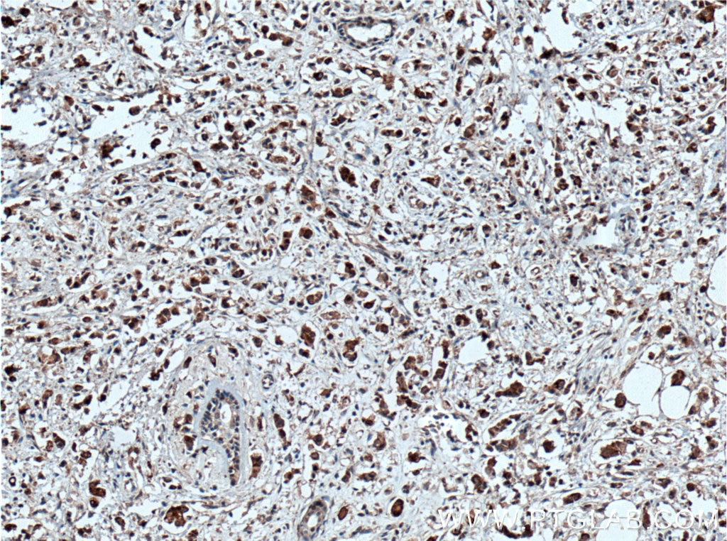Immunohistochemistry (IHC) staining of human breast cancer tissue using OCT4 Monoclonal antibody (60242-1-Ig)