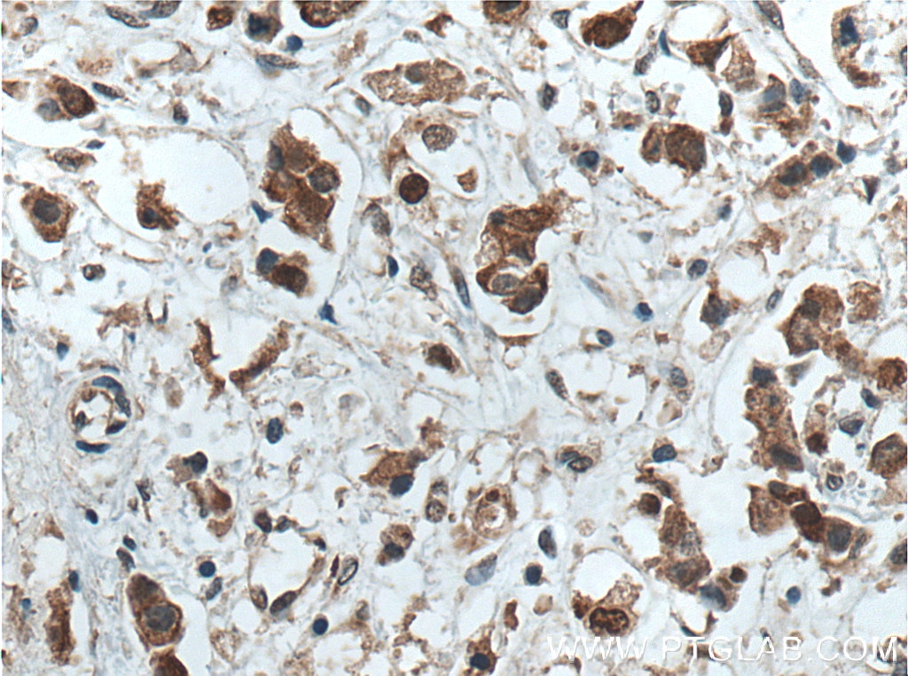 Immunohistochemistry (IHC) staining of human breast cancer tissue using OCT4 Monoclonal antibody (60242-1-Ig)