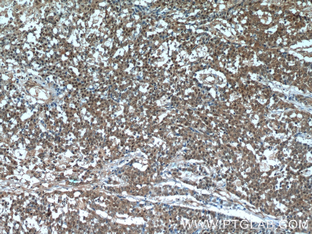 Immunohistochemistry (IHC) staining of human colon cancer tissue using OCT4 Monoclonal antibody (60242-1-Ig)