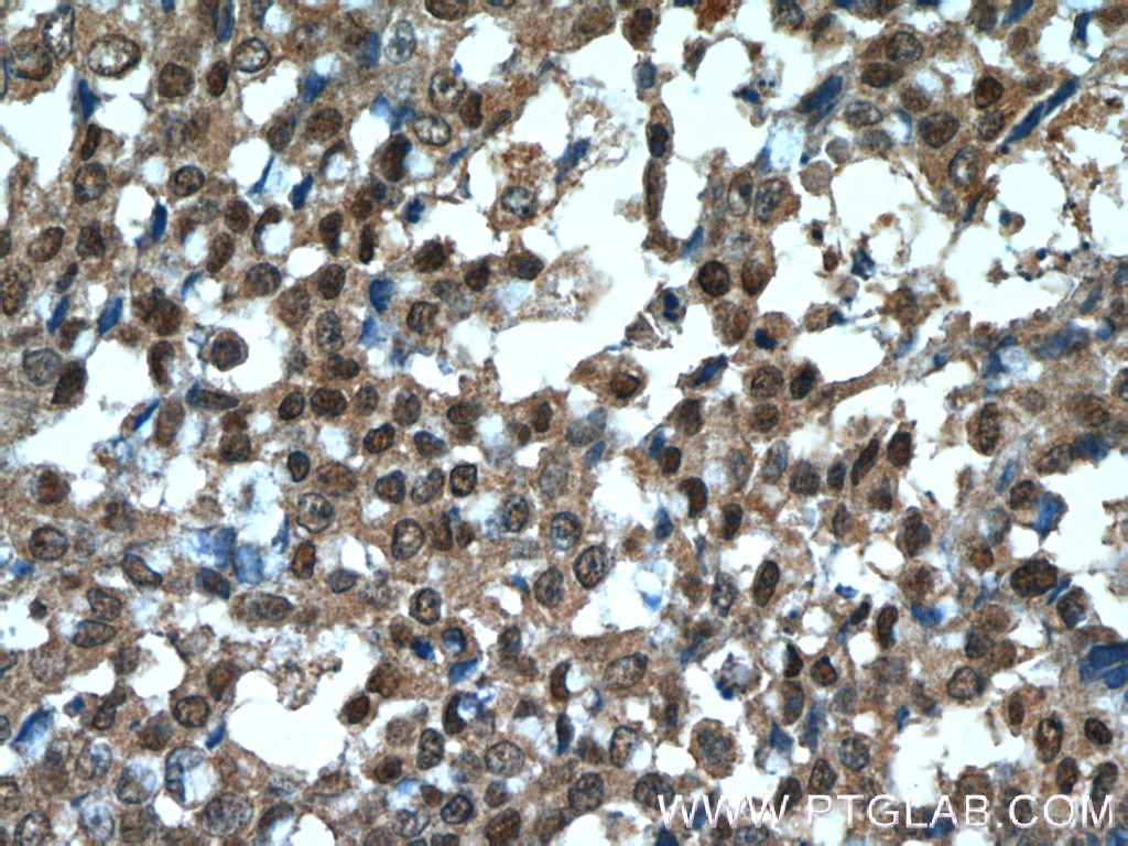 Immunohistochemistry (IHC) staining of human colon cancer tissue using OCT4 Monoclonal antibody (60242-1-Ig)