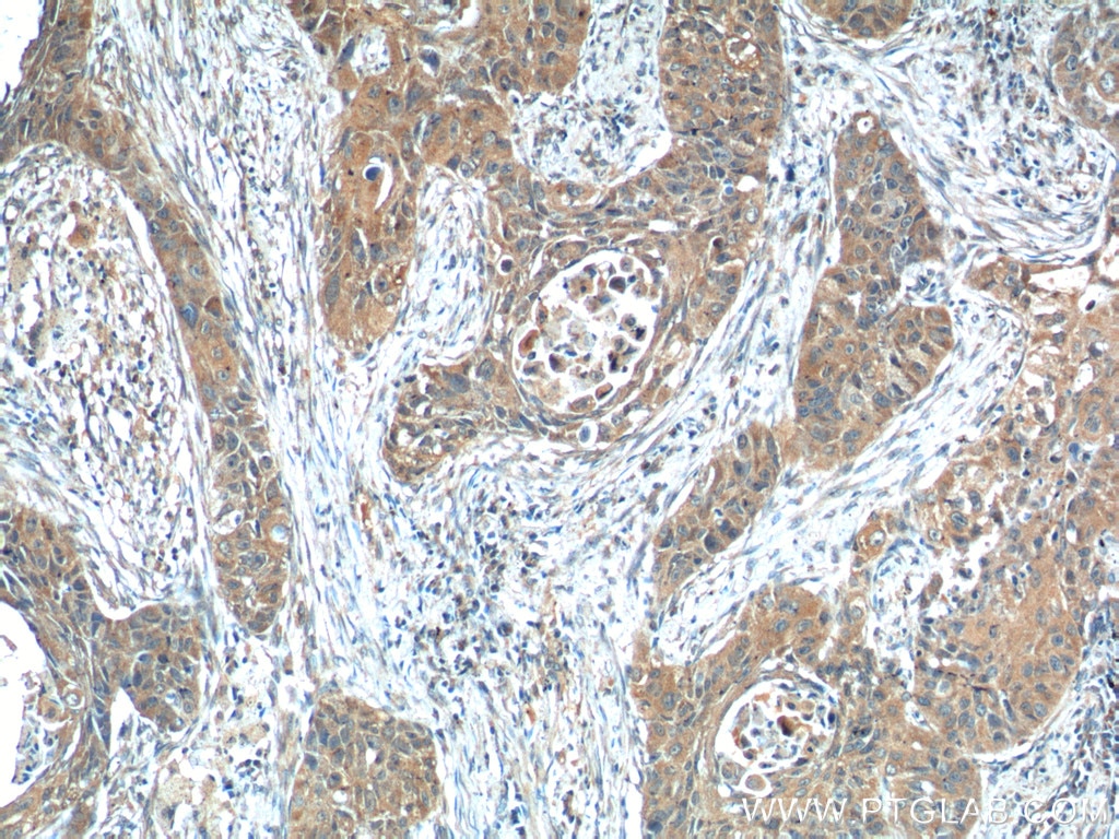 Immunohistochemistry (IHC) staining of human lung cancer tissue using ODAM Polyclonal antibody (16509-1-AP)