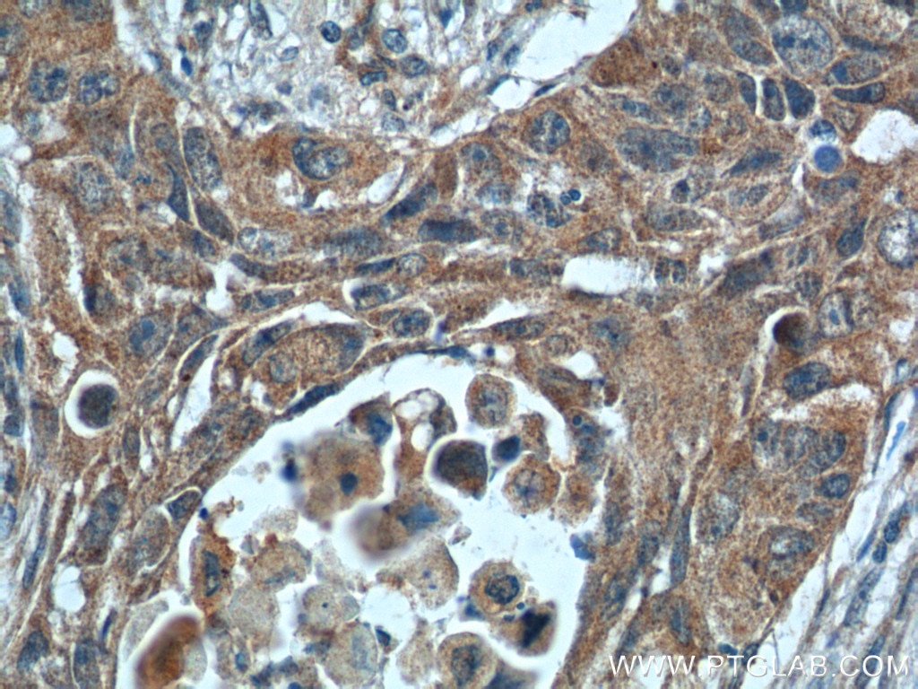 Immunohistochemistry (IHC) staining of human lung cancer tissue using ODAM Polyclonal antibody (16509-1-AP)