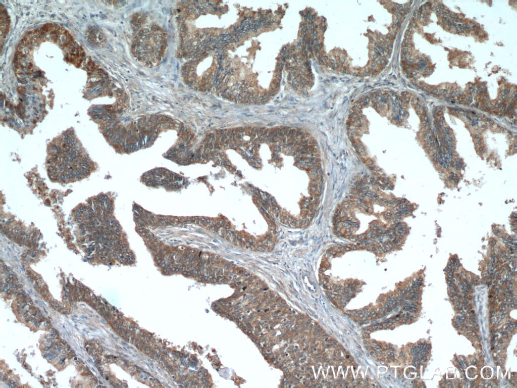 IHC staining of human prostate hyperplasia using 17003-1-AP