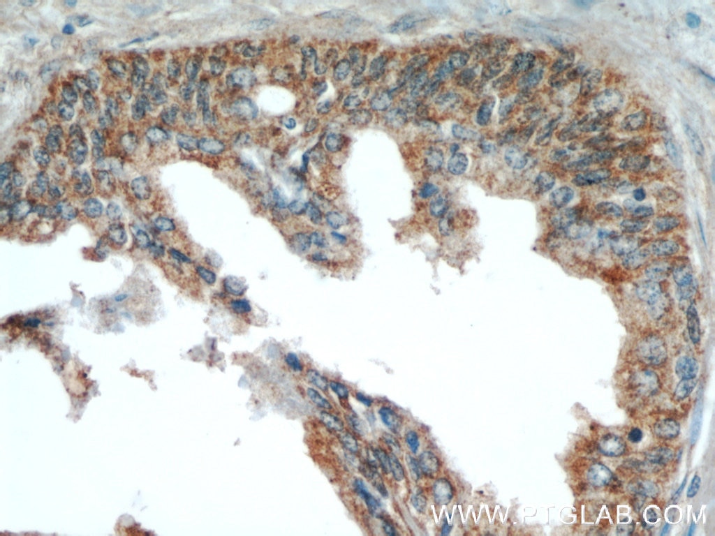 Immunohistochemistry (IHC) staining of human prostate hyperplasia tissue using ODC1 Polyclonal antibody (17003-1-AP)